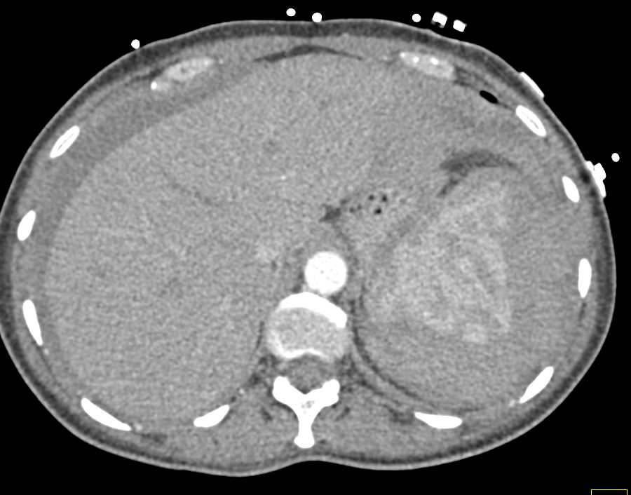 Splenic Laceration with Hemoperitoneum - CTisus CT Scan