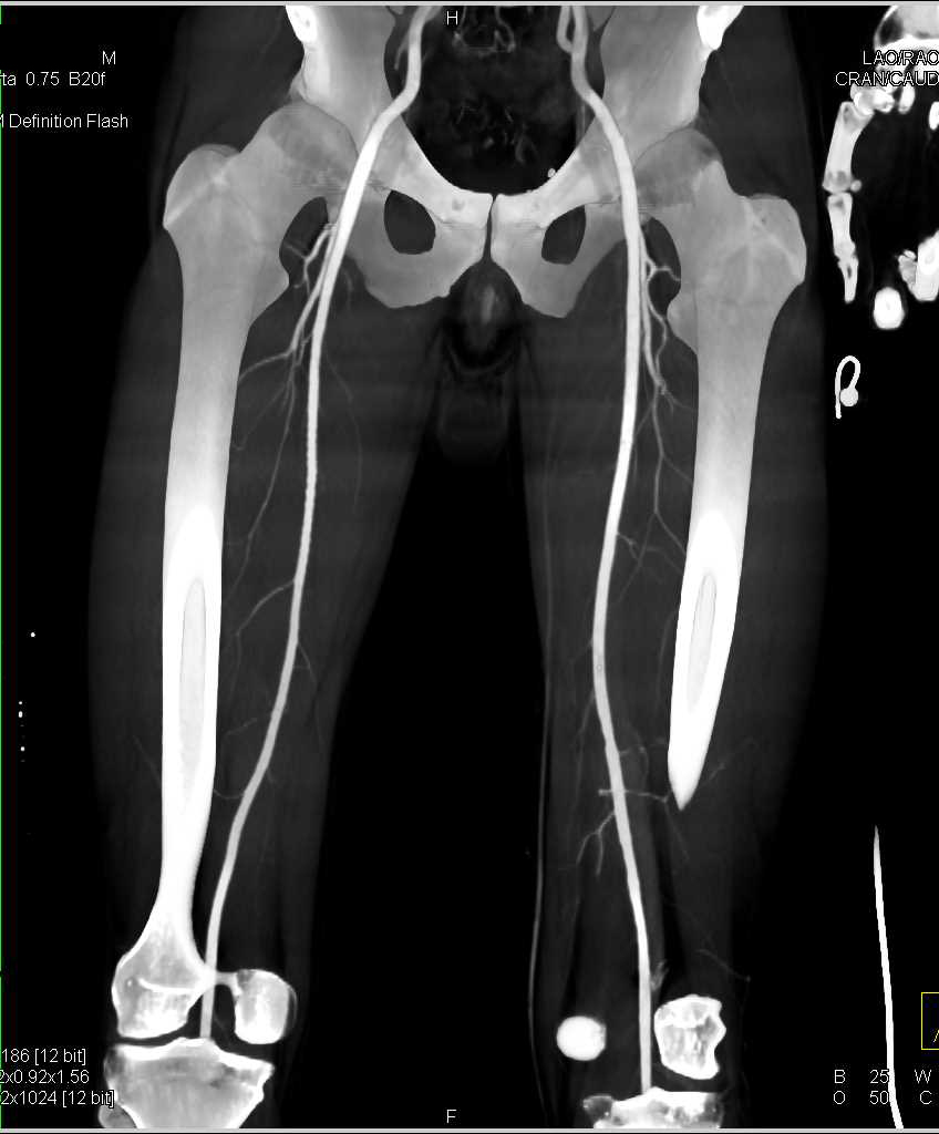 Spiral Fracture Tibia and Fibula Without Vascular Injury - CTisus CT Scan