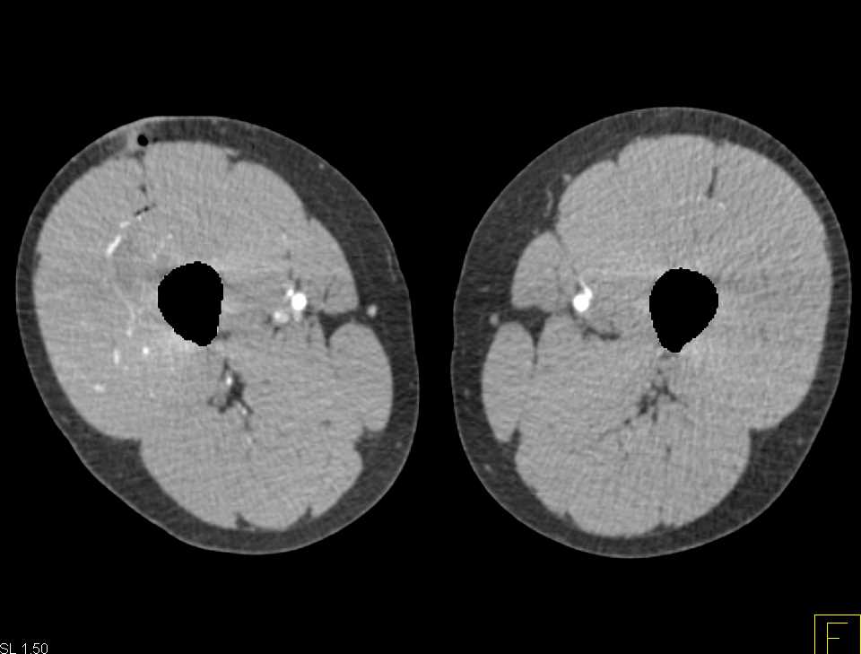 Stab Wound Right Thigh with Increased Vascular Flow - CTisus CT Scan