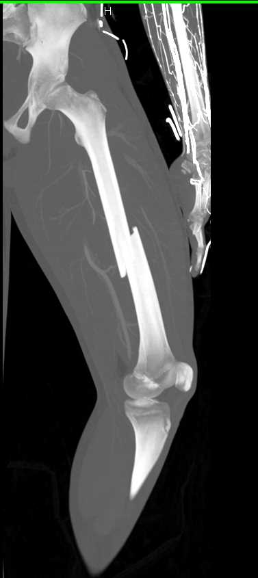 Mid-Femur Fracture Without Vascular Injury - CTisus CT Scan