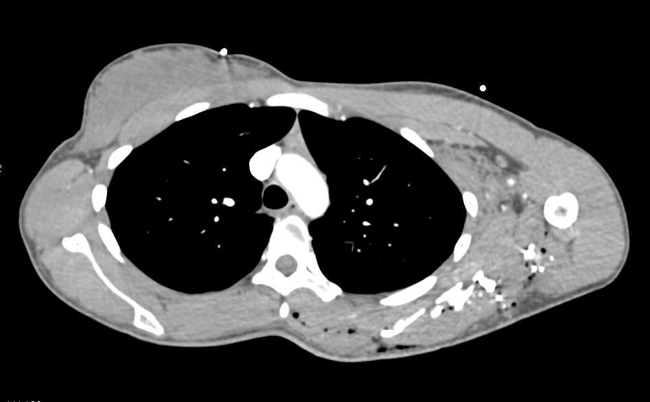 Mid-Femur Fracture Without Vascular Injury - CTisus CT Scan