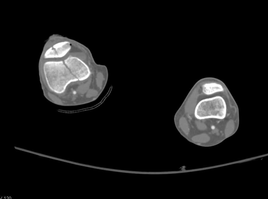 Femur and Patellar Fractures with Accurate Mapping - CTisus CT Scan