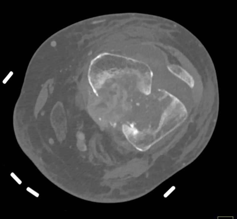 Comminuted Fracture Distal Femur - CTisus CT Scan