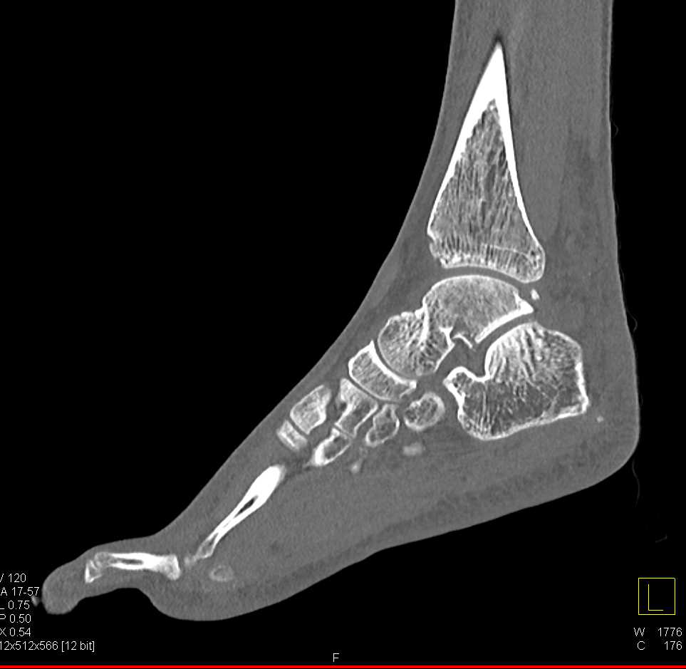 Multiple Fractures including Tibia and Talus - CTisus CT Scan