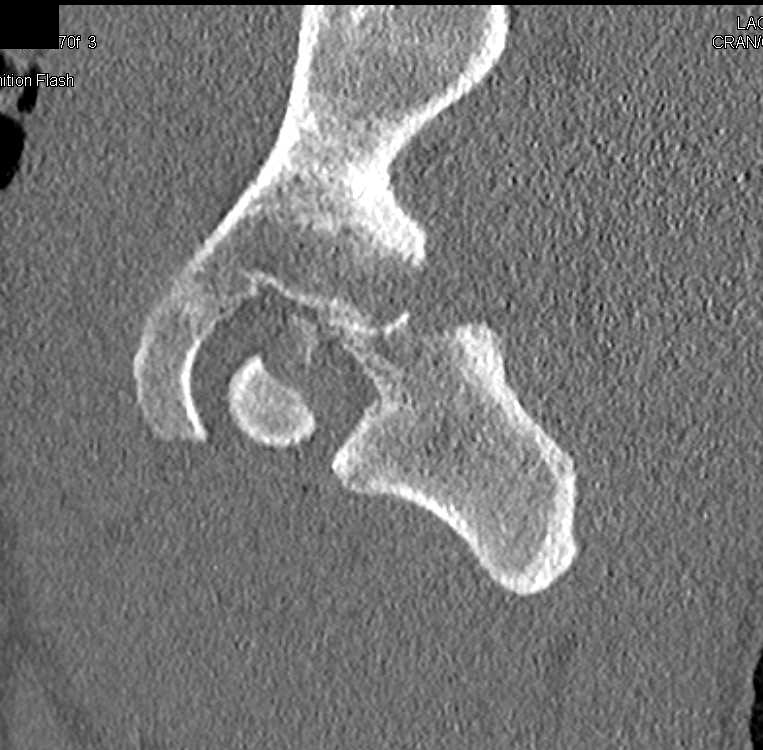 Fracture Acetabulum with Hematoma and Dislocation with Bone Fragment in the Hip Joint - CTisus CT Scan