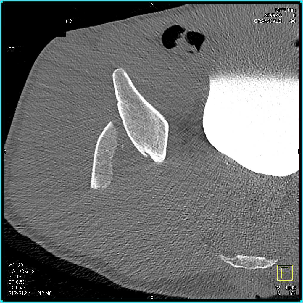 Fracture Acetabulum with Hematoma and Dislocation with Bone Fragment in the Hip Joint - CTisus CT Scan