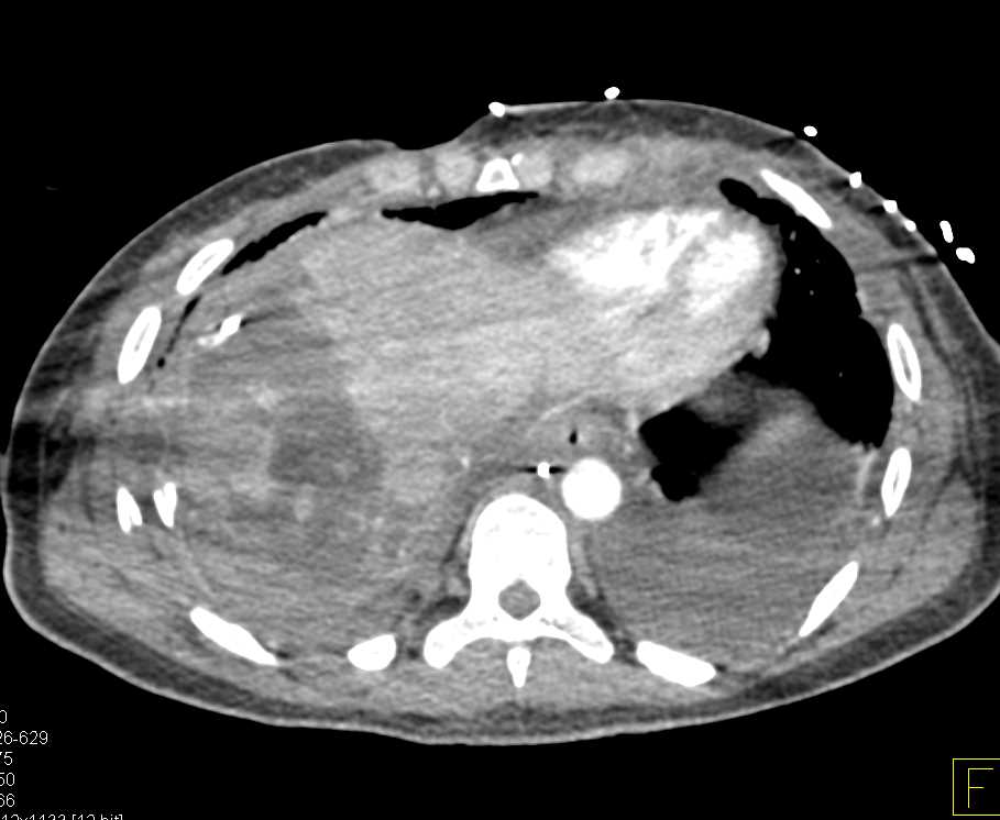 Liver and Renal Laceration s/p Trauma - CTisus CT Scan