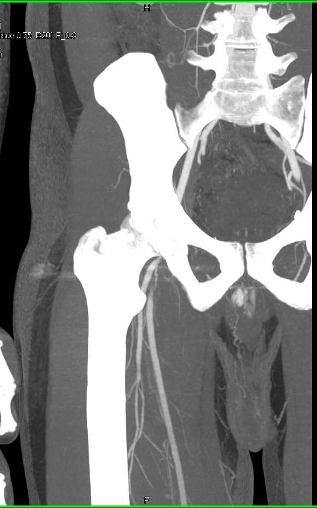 GSW Thigh Without Vascular Injury - CTisus CT Scan