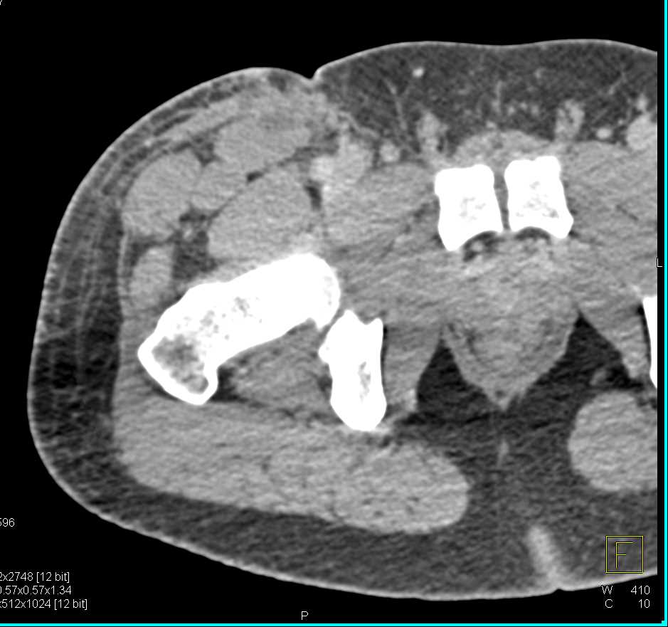 GSW Thigh Without Vascular Injury - CTisus CT Scan