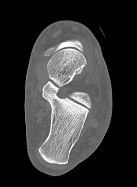 Talus Fracture - CTisus CT Scan