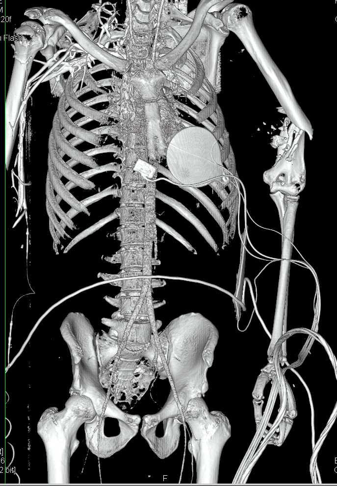 Humerus Fracture with Vascular Injury - CTisus CT Scan