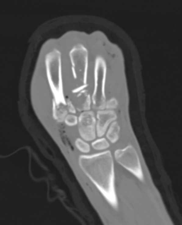 Comminuted Fracture Hand with Open Wound - CTisus CT Scan