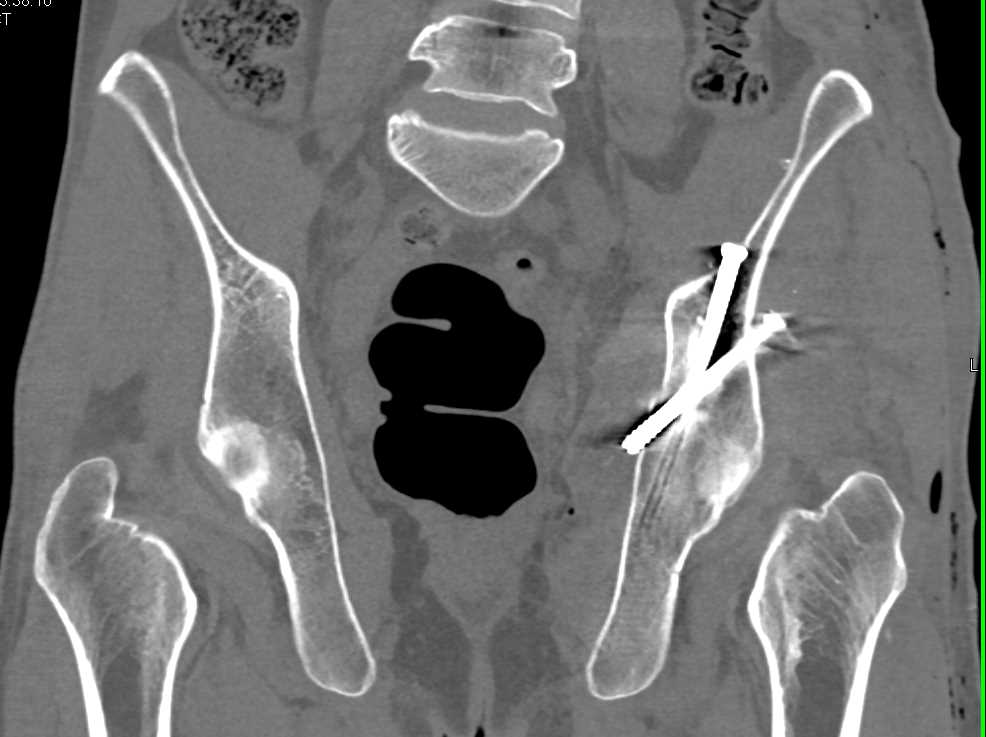 Repair of Left Acetabular Fracture - CTisus CT Scan