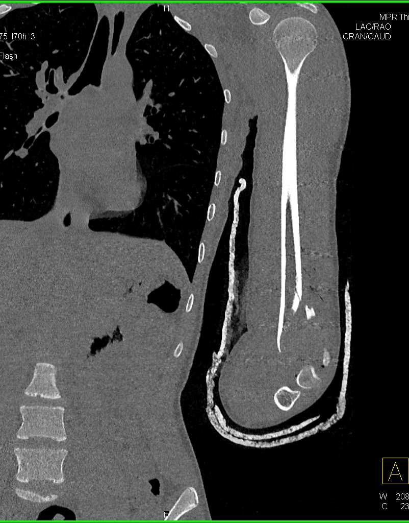 Distal Humerus Fracture - CTisus CT Scan