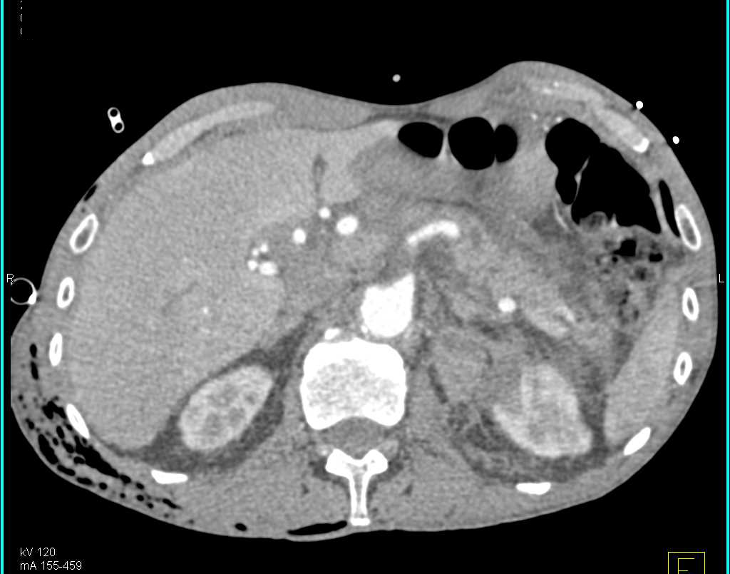 Trauma with Pelvic Trauma and Injury to Left Kidney and Adrenal Gland - CTisus CT Scan