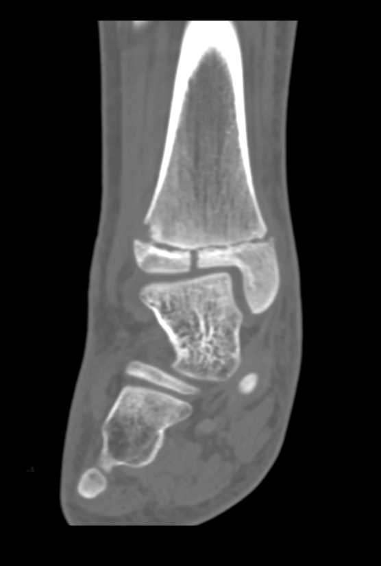 Tibial Fracture with Multiple Renderings - CTisus CT Scan