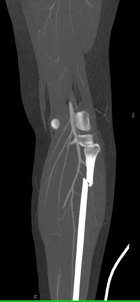 Tibia/Fibular Fracture with CTA Post Trauma - CTisus CT Scan
