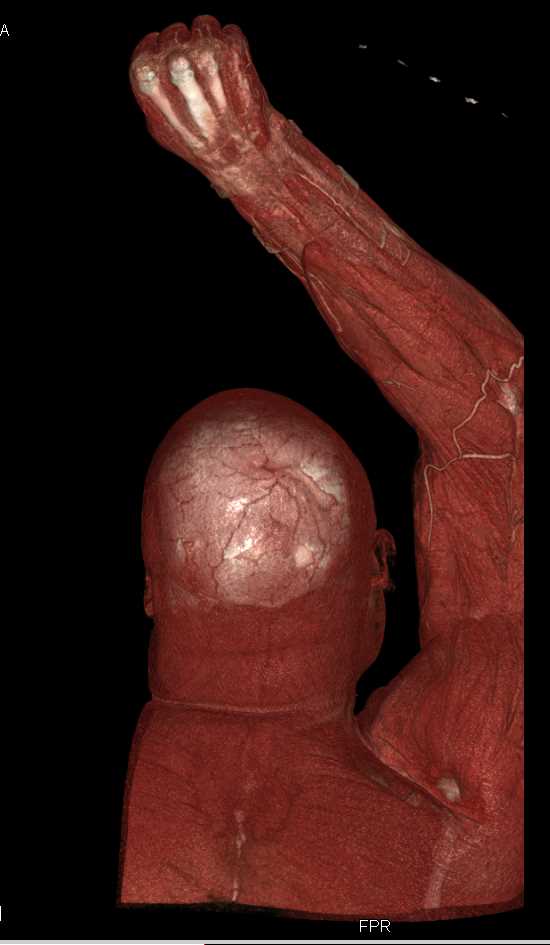 Gunshot Wound (GSW) and Patent Vasculature - CTisus CT Scan