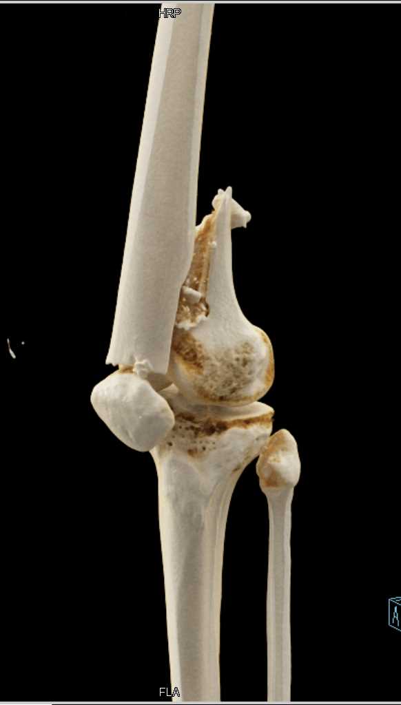 Femur Fracture Without Vascular Injury and Cinematic Rendering - CTisus CT Scan