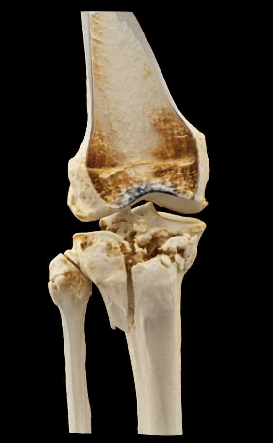 Tibial Plateau and Fibular Fractures - CTisus CT Scan