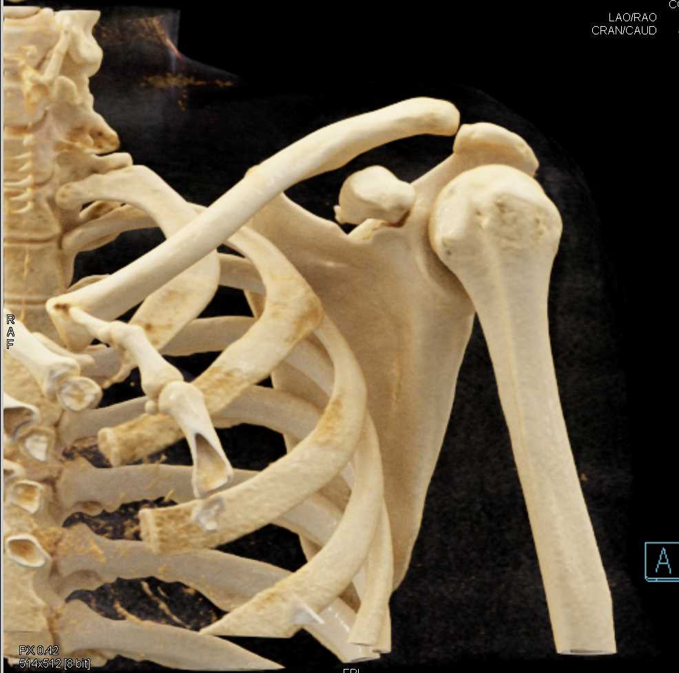 Scapular Fracture with Cinematic Rendering - CTisus CT Scan