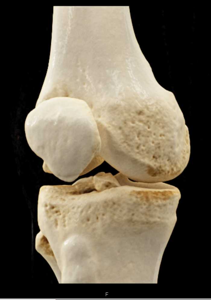 Tibial Plateau Fracture with Cinematic Rendering - CTisus CT Scan