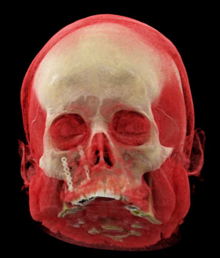 Orbital Fracture Post Repair - CTisus CT Scan