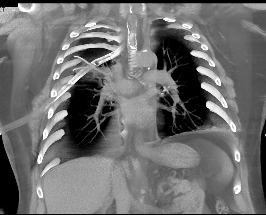 Chest Trauma with Rib Fractures - CTisus CT Scan