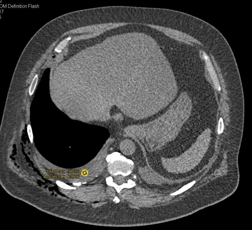 Chest Trauma with Rib Fractures - CTisus CT Scan