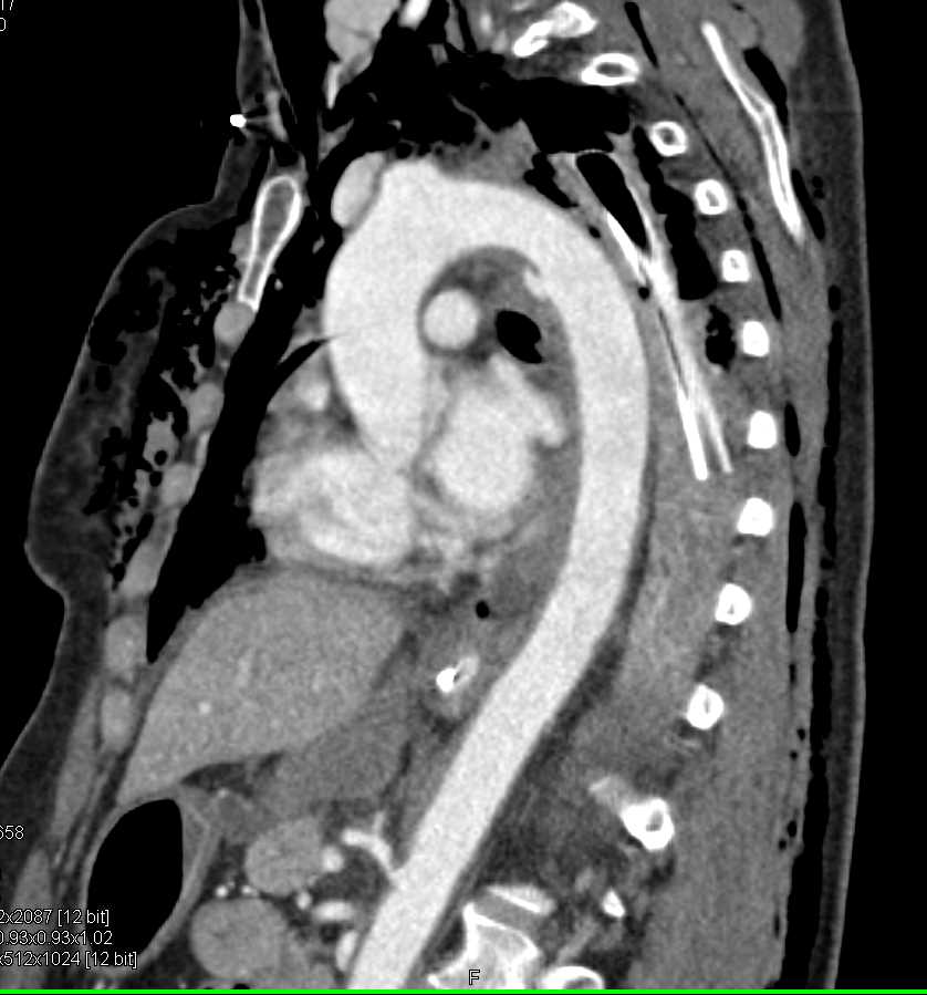 Aortic Transection s/p Trauma - CTisus CT Scan