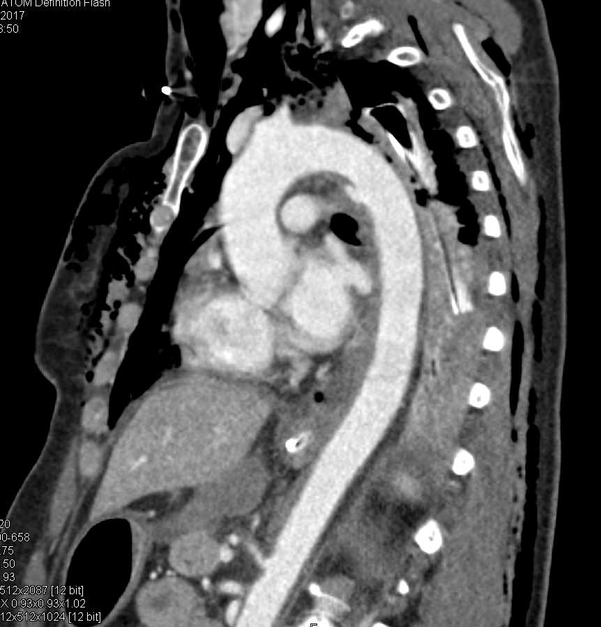 Aortic Transection s/p Trauma - CTisus CT Scan