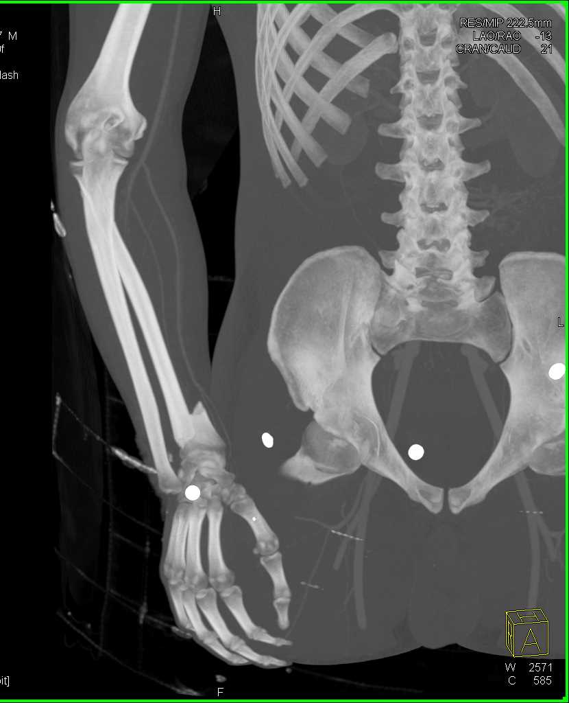 Fracture Dislocation at the Level of the Wrist - CTisus CT Scan