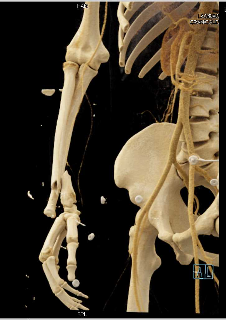 Fracture Dislocation at the Level of the Wrist - CTisus CT Scan