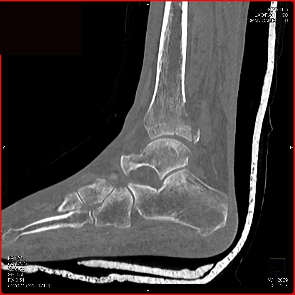 Tibia and Fibular Fractures - CTisus CT Scan