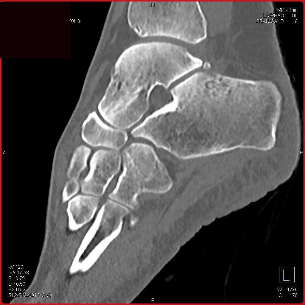 Calcaneus and Cuboid Fractures - CTisus CT Scan