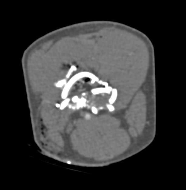 Gunshot Wound (GSW) Femur with Comminuted Fracture with Intact Vascular Map - CTisus CT Scan