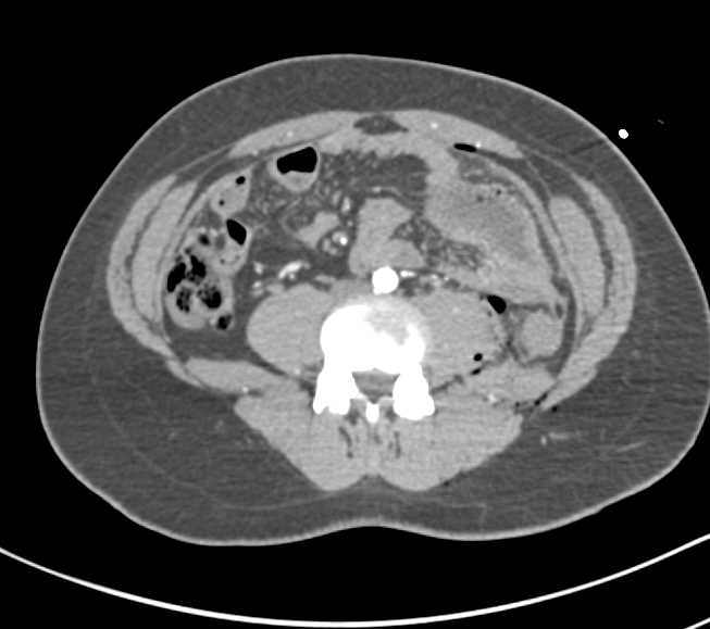 Gunshot Wound (GSW) Without Key Vascular Injury - CTisus CT Scan