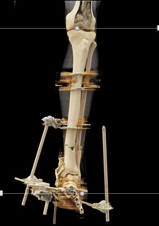 Tibia and Fibula fractures with External Fixation - CTisus CT Scan