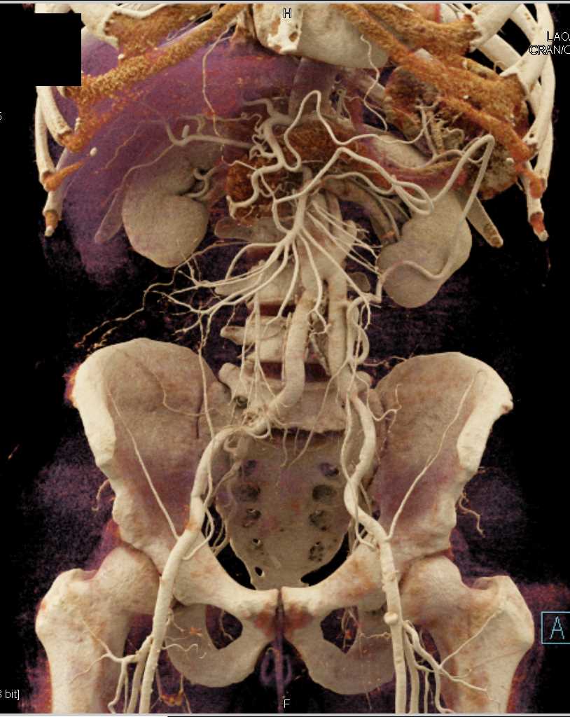 Aortic Aneurysm Repair with Cinematic Rendering - CTisus CT Scan