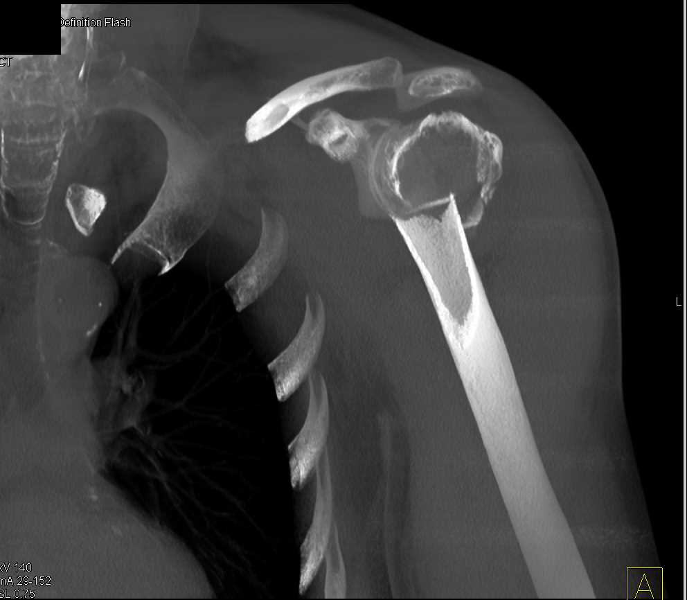 Comminuted Fracture Left Humerus - CTisus CT Scan