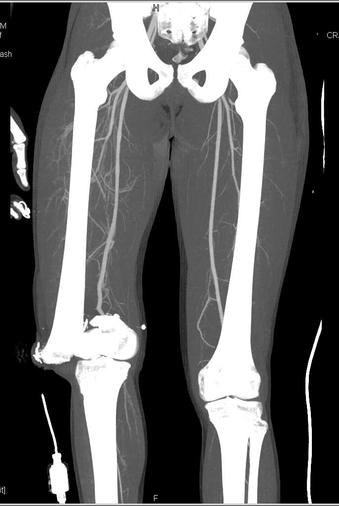 Fracture Distal Femur Without Vascular Injury - CTisus CT Scan