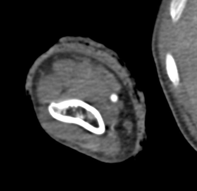 Trauma Without Vascular Injury - CTisus CT Scan