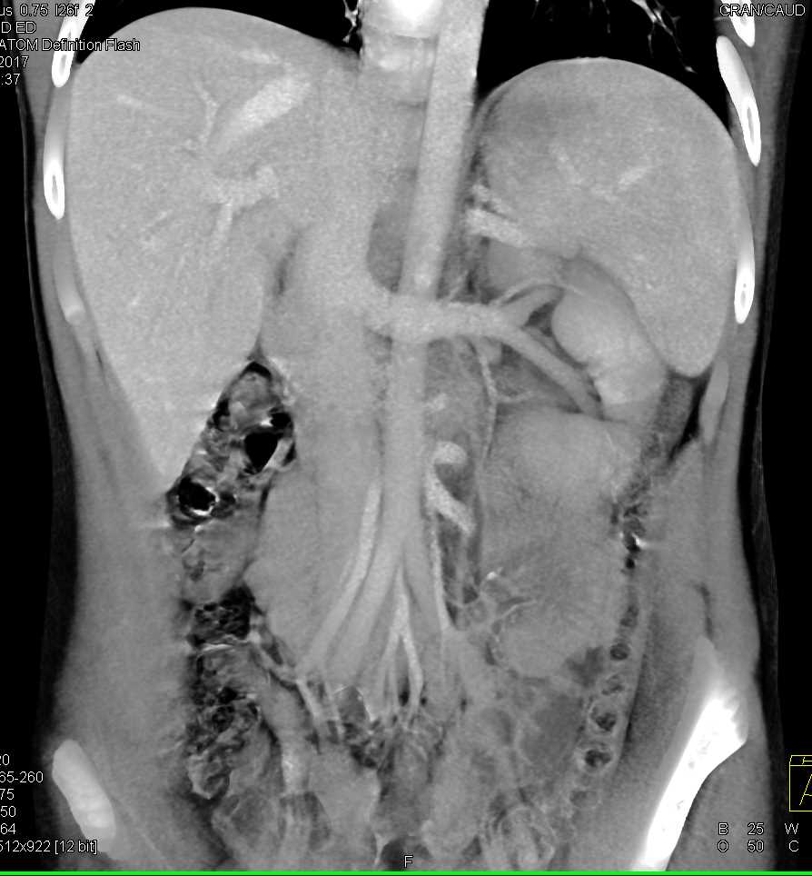 Renal Laceration Left Kidney with Peri-renal Bleed - CTisus CT Scan