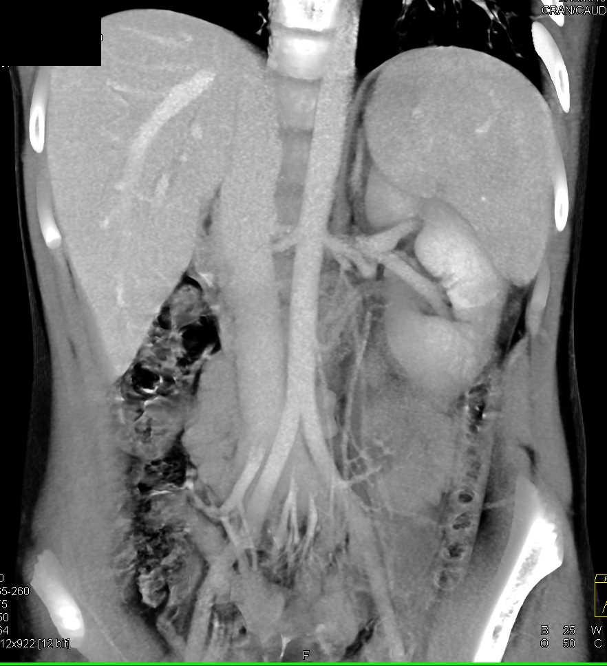 Renal Laceration Left Kidney with Peri-renal Bleed - CTisus CT Scan