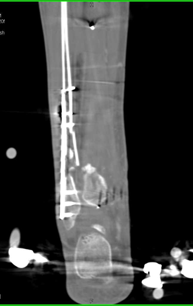 Hardware for Repair of the Tibia and Fibula Fractures - CTisus CT Scan