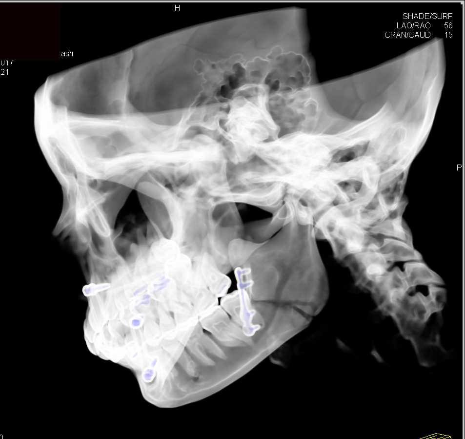 Mandibular Fracture with Repair - CTisus CT Scan