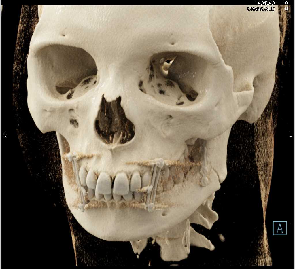 Mandibular Fracture with Repair - CTisus CT Scan