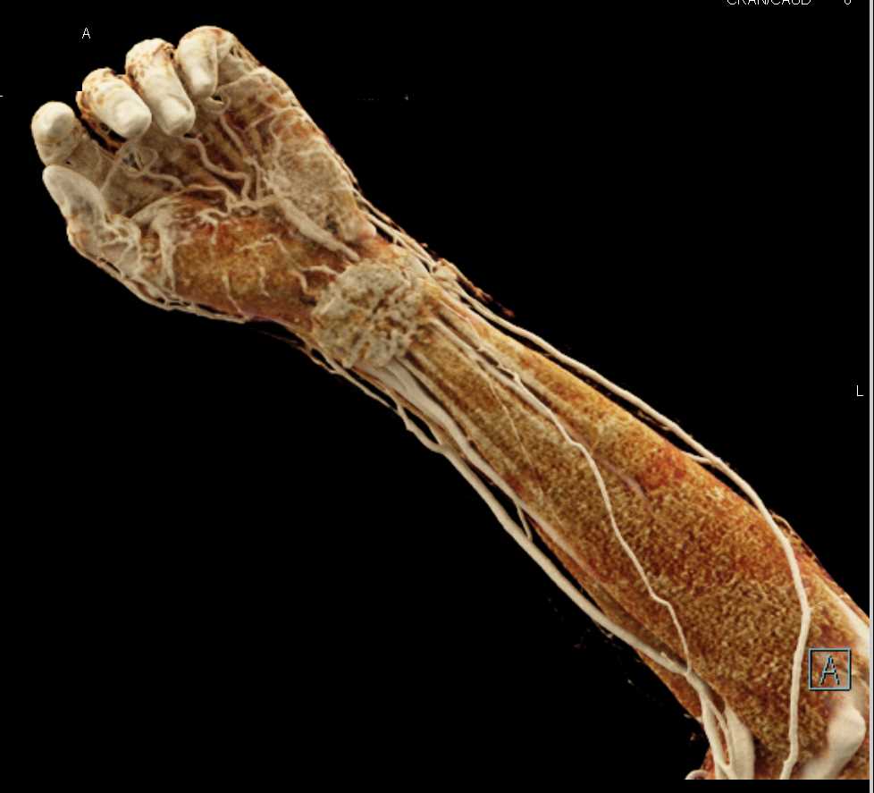 Laceration Thru the Wrist with CTA - CTisus CT Scan