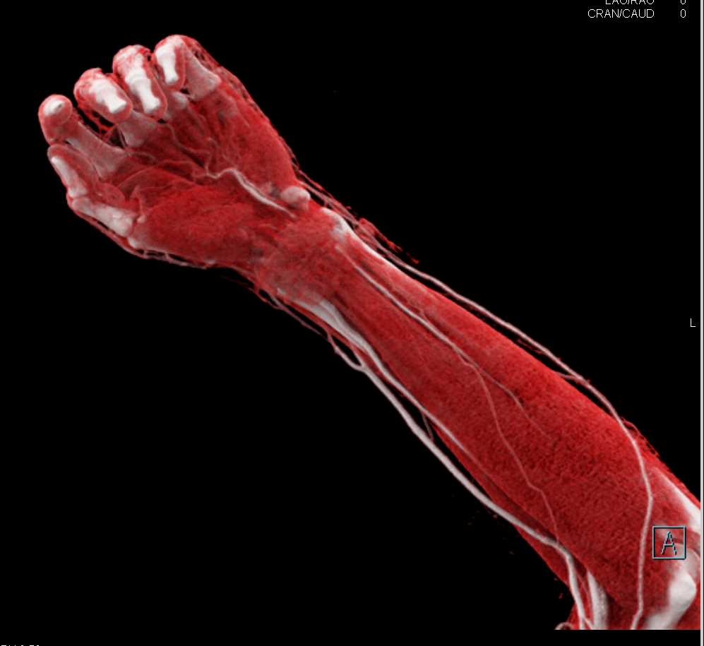 Laceration Thru the Wrist with CTA - CTisus CT Scan