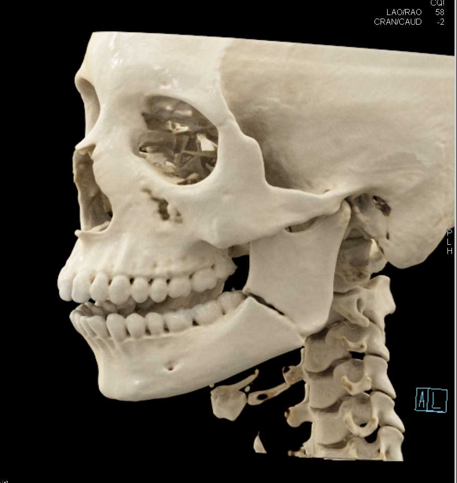 Mandibular Fracture - CTisus CT Scan